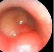 研究发现常见的巨响会导致内耳积液